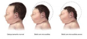 foto bebe microcefalia 300x135 - Gravidez, vírus zika e microcefalia: tire suas dúvidas